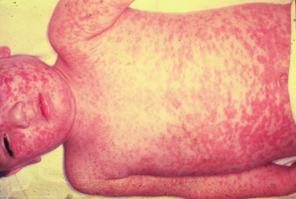 child with measles 